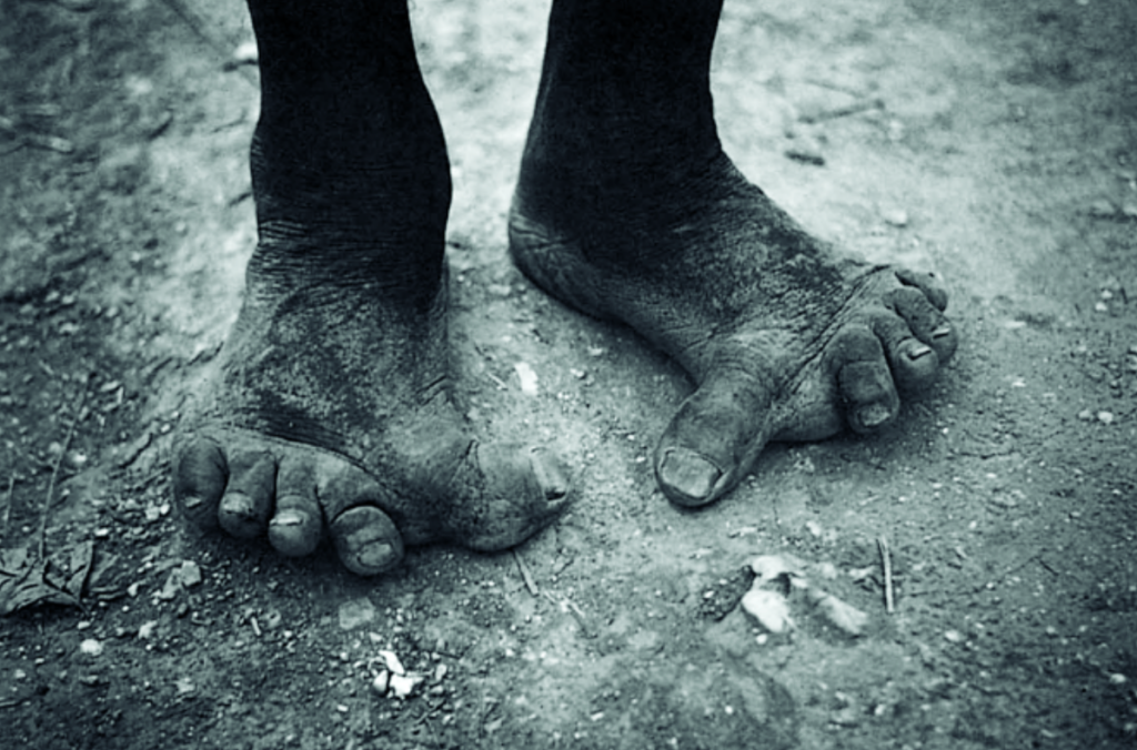 Photograph by Michael Ward depicting the deformed feet of a Nepalese highlander.